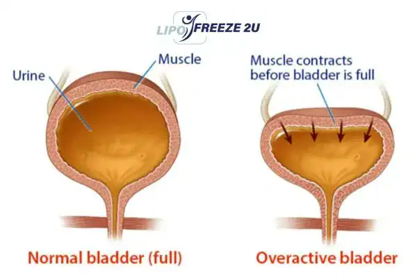 diagram of overactive bladder treatment Basingstoke