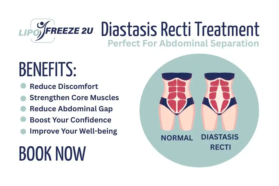 How Long Will It Take to See Improvements in Diastasis Recti Basingstoke