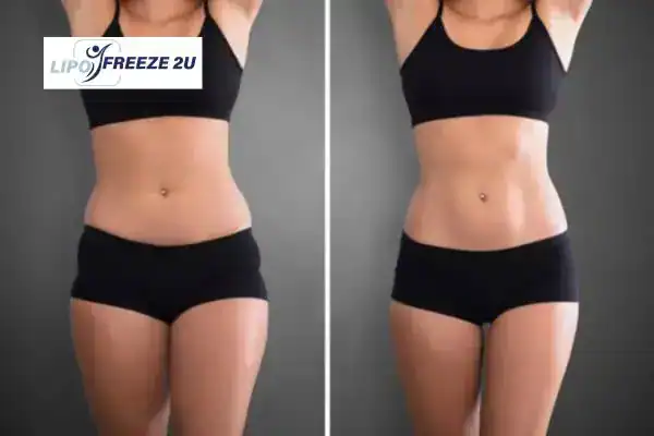 How Can LIPO FREEZE 2U Support Your Post-Pregnancy Body Recovery Basingstoke?