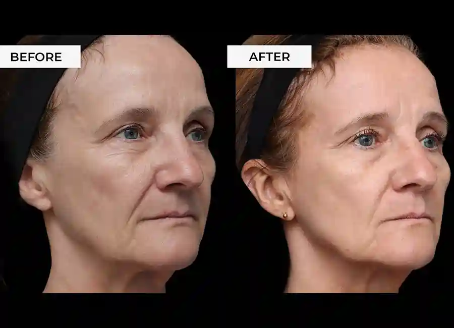How Many RF Microneedling Sessions Will You Need to See a Difference Basingstoke?