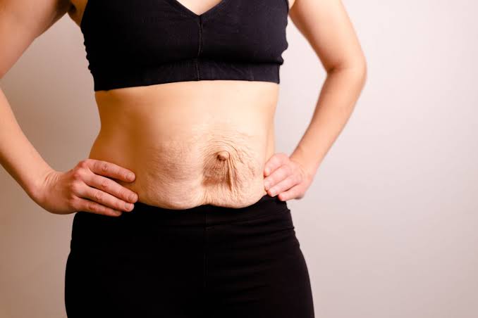 Is Surgery Really the Only Way to Repair Diastasis Recti Basingstoke?