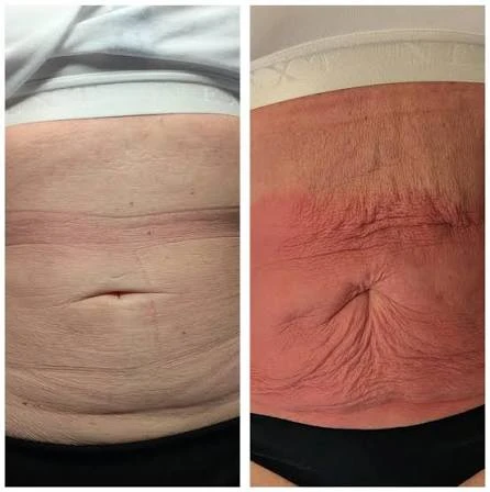 How Does RF Microneedling Improve Crepey, Thin and Uneven Skin Texture Basingstoke?