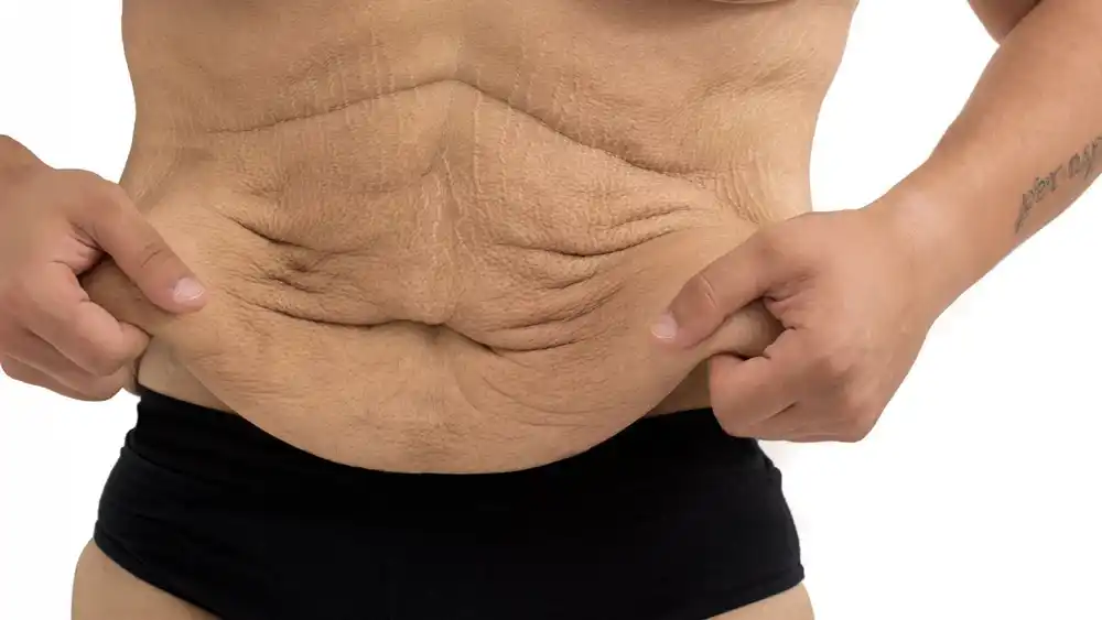Why Does Weight Loss Medication Leave Some People With Loose or Sagging Skin Basingstoke?